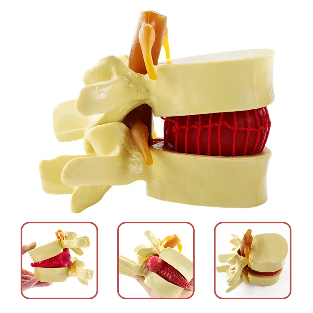 

Model Spine Lumbar Herniation Disc Human Models Anatomical Vertebrae Anatomy Vertebral Teaching Intervertebral Chiropractic