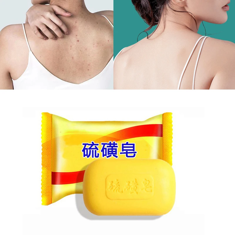 

Sulfur Soap Oil-Control Acne Treatment Psoriasis Seborrhea Eczema Anti Fungus Perfume Butter Bubble Bath