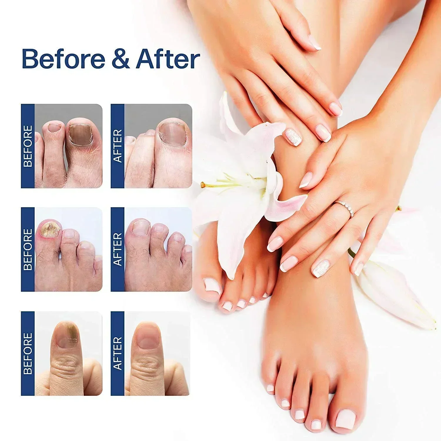Nail Fungus Treatment Toenail Nail Repair Fingernail Device Essential Oil Onychomycosis Care