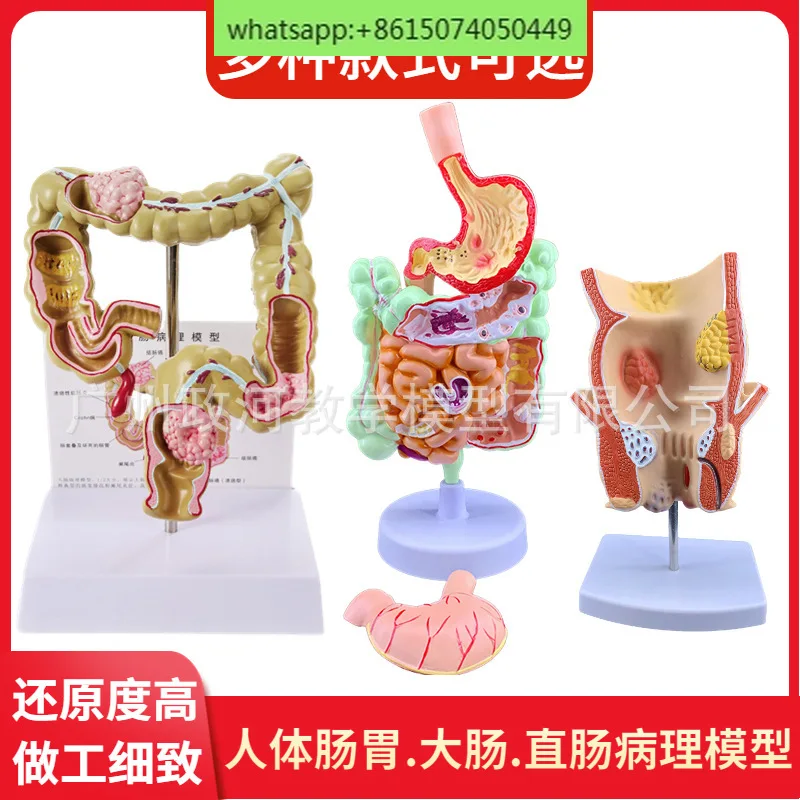 

Human colon pathology, rectal hemorrhoids display, colon anatomical organ structure model, twelve finger gastrointestinal system