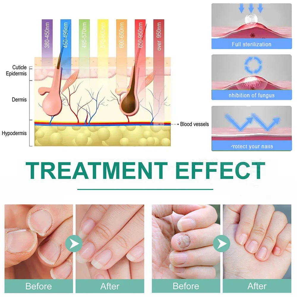 Fungal Nail Treatment Device Repair Fast Nails Fungus Onychomycosis Repair Toenail Fingernail Removes Nail Fungus Foot Care