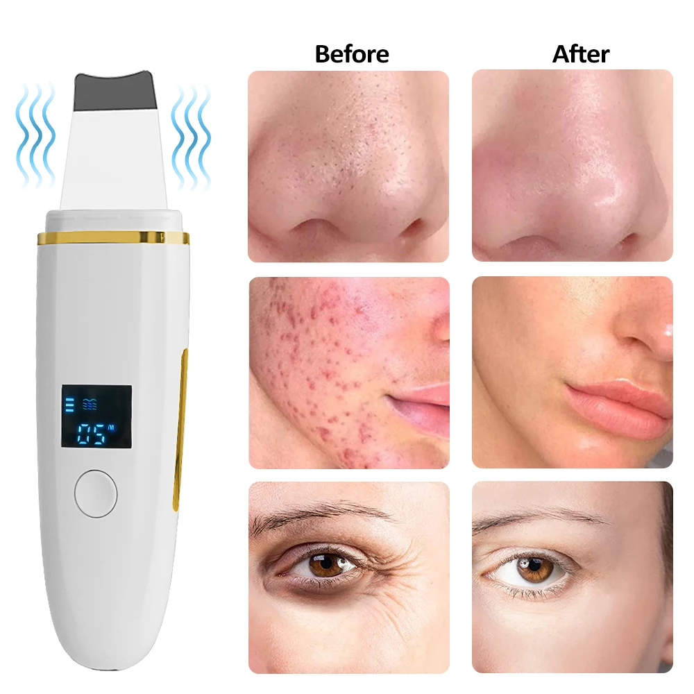 Face Skin Scrubber Ultrasonic Face Shovel Cleaning Dead Skin Peeling Acne Pore Spatula Deep Cleaner EMS Blackhead Remover Device