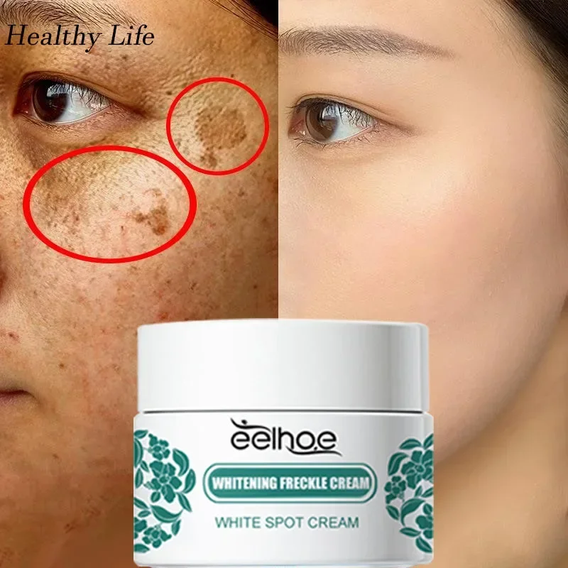 Niacinamide Remove Spot Whitening Cream Fade Pigmentation Freckle Cream Reduces Dark Spots Melasma Serum Anti-aging Face Care