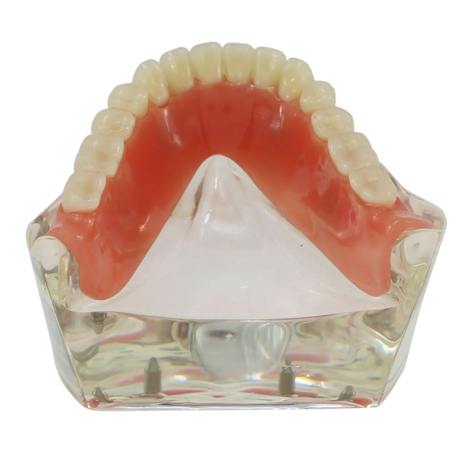 NEW Dental Implant Tooths Model Overdenture Inferior with 4 Implants Demo #6003