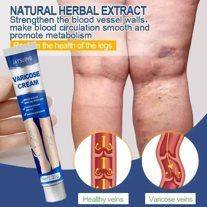 Ointment for Varicose Veins Eliminate Vasculitis Phlebitis to Relieve Spider Leg Pain Treatment Herbal cream 5