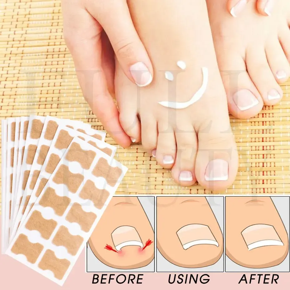 Ingrown Toenail Correction Sticker Adhesive Toenail Patch Elastic Nail Treatment Corrector Sticker Foot Care Tools