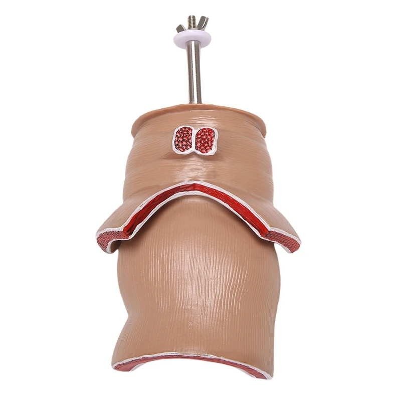 Anatomy Model Human Rectal Hemorrhoid Lesion Model Hemorrhoid Fistula Fistula Fissure Pathology Teaching Model 6