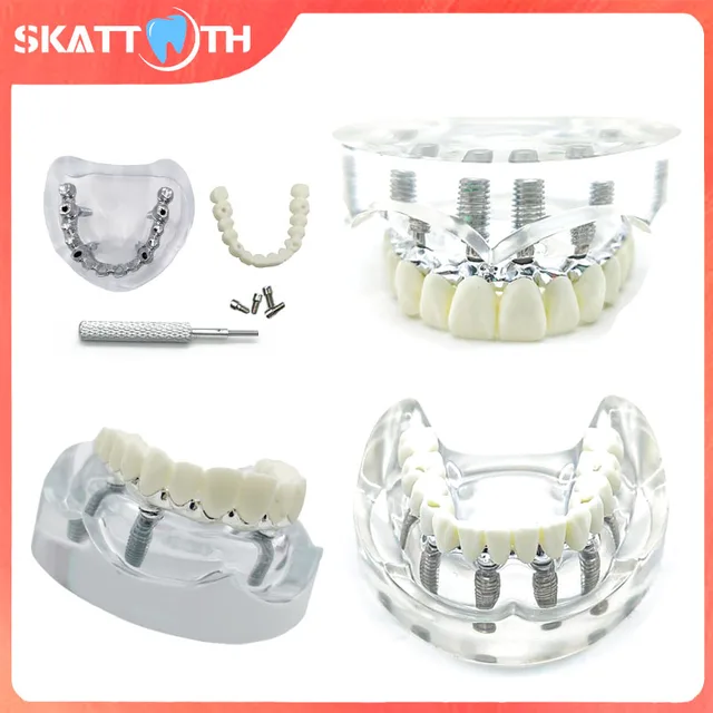 1Pc Dental Implant Model Upper Lower Jaw 4/6 Implants Overdenture Restoration Removable Teeth Model Dentisit Teaching Demo Model