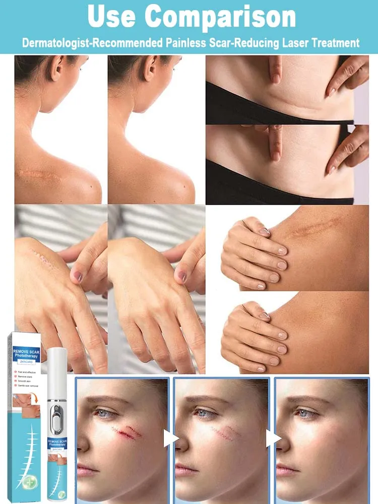 laser scar Suitable for all scar types