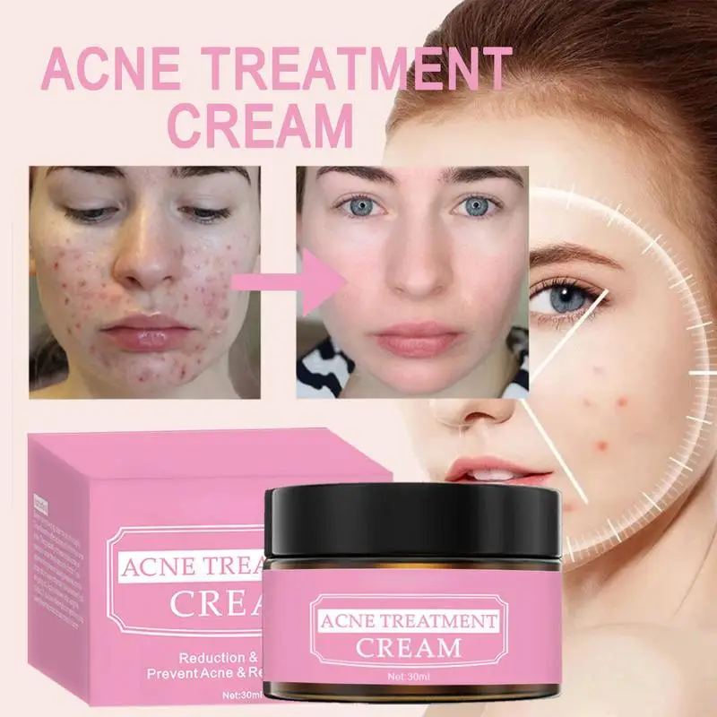 Remove acne mild repair acne pits acne marks nourishing moisturizing hydrating acne cream salicylic acid acne muscle repair cotton pads remove oil improve oil acne remove closed acne blackheads fade acne marks clean