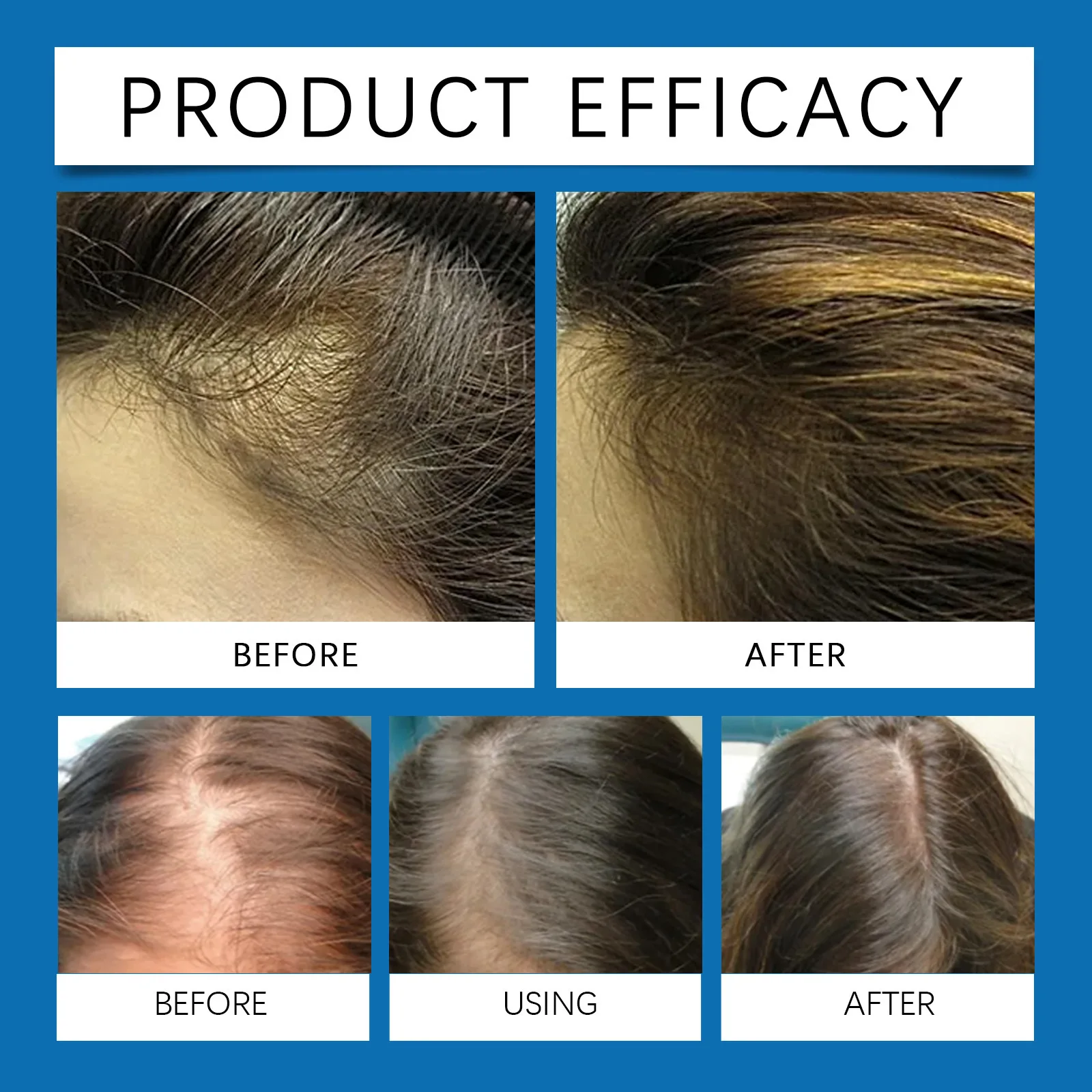 HOEGOA blue bottle.hair growth essential 0iI. Say goodbye to baIdness. The secret 0f thick hair hair growth serums