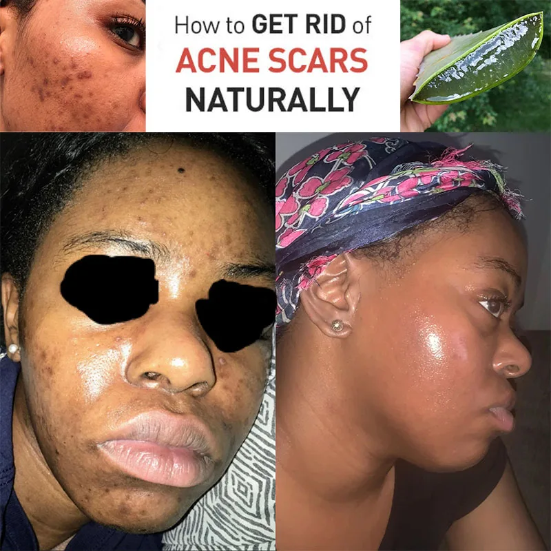 

aloe gel Acne Removal Creams Solution for Acne Scars Salicylic Acid Antibacterial Pore Cleaner Allantoin Exfoliator Skin Repair