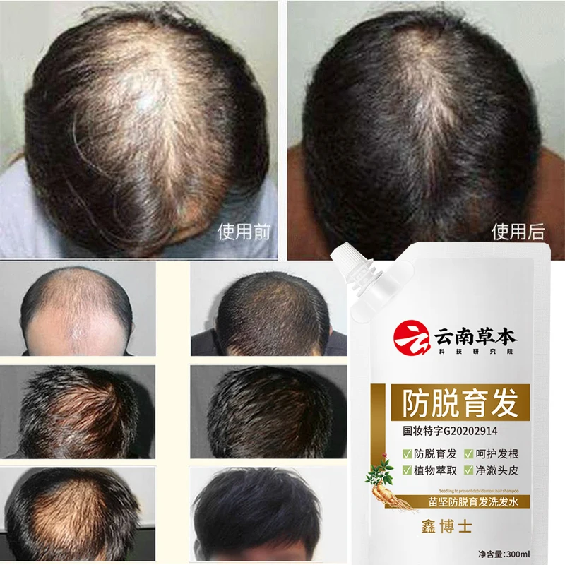 Popular 300ml Yunnan Herbal Seedling Strong Anti peeling and Nourishing Shampoo Cleansing Clear Scalp Anti peeling Shampoo