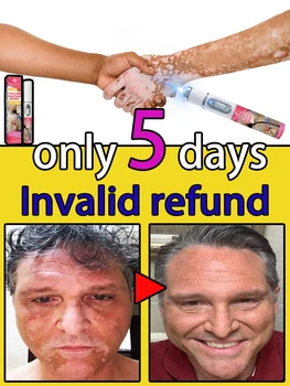 laser vitiligo