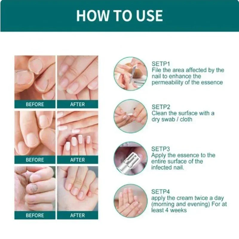 5Nail Fungals Renewal Nail Repair Liquid for Discolored Thickened Crumbled Nails Nail Fungals for Discolored Broken Cracked XXS5
