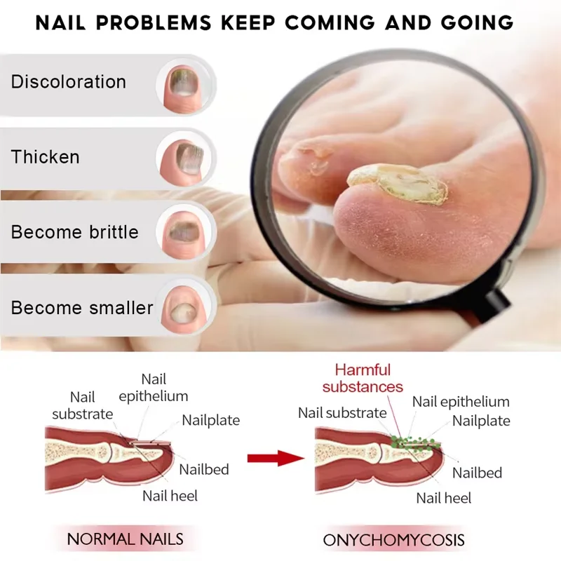 7Days Nail Fungus Treatment Serum Ginger Anti-infective Paronychia Onychomycosis Toe Foot Nail Fungal Repair Gel Hand Foot Care nail fungus treatment