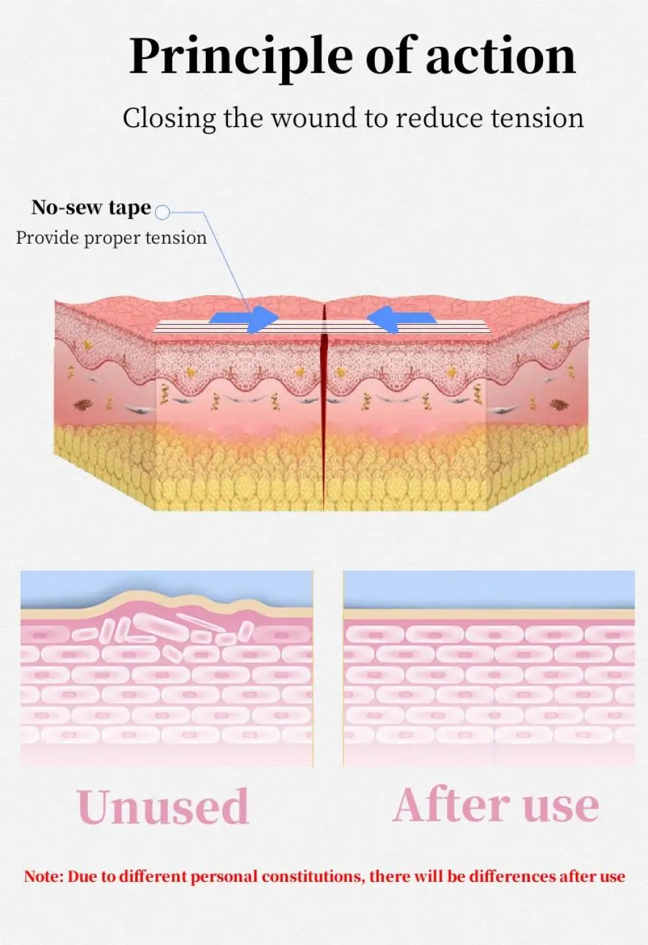 Description Picture 4 of itemSeam-Free Tape Medical Pull-Free Seam-Free Tape Wound Wound Suture Closed Dressing Breathable Skin Repair