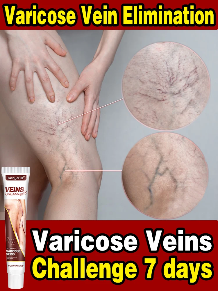 

Effective Varicose Vein Relief Cream Eliminate Vasculitis Phlebitis Spider Legs Treatment Soothing Relieve Pain Herbal Ointment