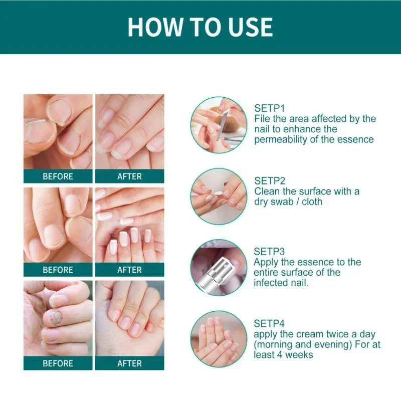 Beauty Health Nail Fungus Treatment Anti-Infection Nail Fungal Removal Essence Nails Fungus Treatments Serum Spray Repair Toe
