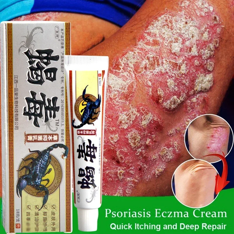 

Psoriasis Cream Eczema Ointment Scalp Psoriasis Hand Tinea Foot Odor Tinea Versicolor Inhibit Fungus Anti-itch Tinea Scorpion