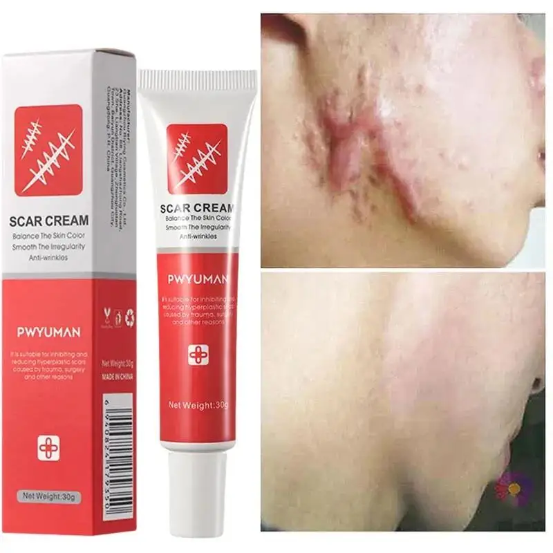 

Fast Scar Removal Cream Stretch Marks Repair Burn Surgery Treat Gel Keloids Acne Pox Prints Removal Ointment Smooth Skin Care