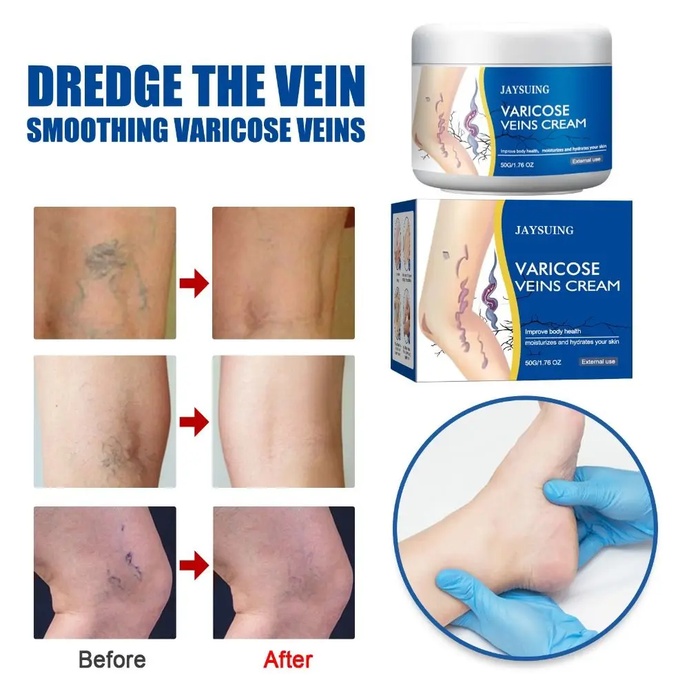 50g/1.76fl.oz Legs Varicose Veins Treatment Pain Relief Mild & Safe Legs Skin Cream Moisturizes The Skin