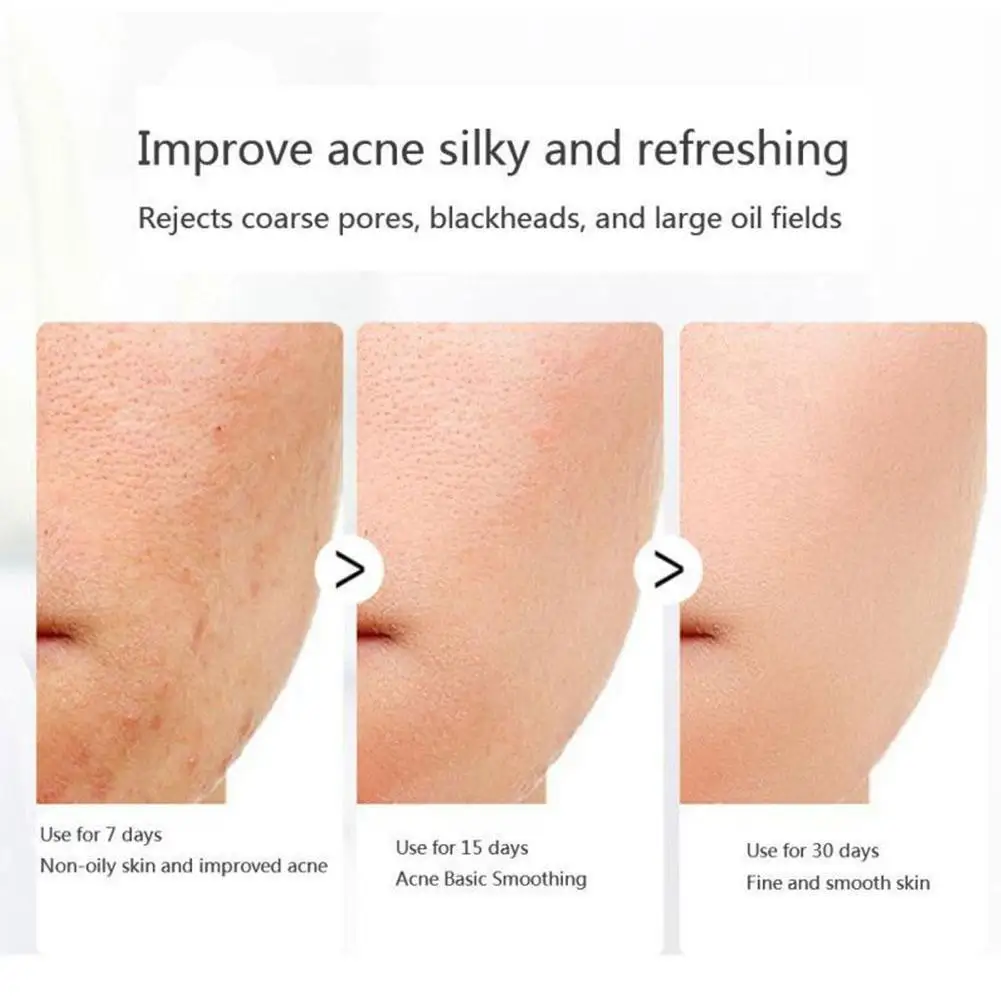 Рисунок 5 - Мыло для удаления акне