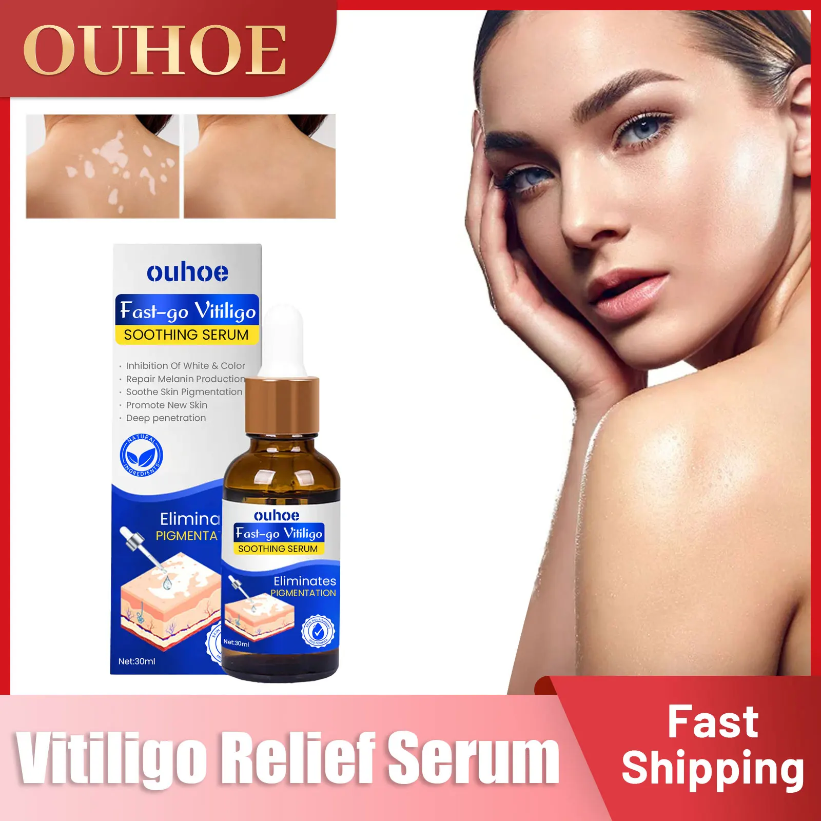 

Vitiligo Treatment Serum Pigment Growth Lamp Ringworm Tinea Sweat White Spots Removal Leukoplakia Treatment Health Care Essence