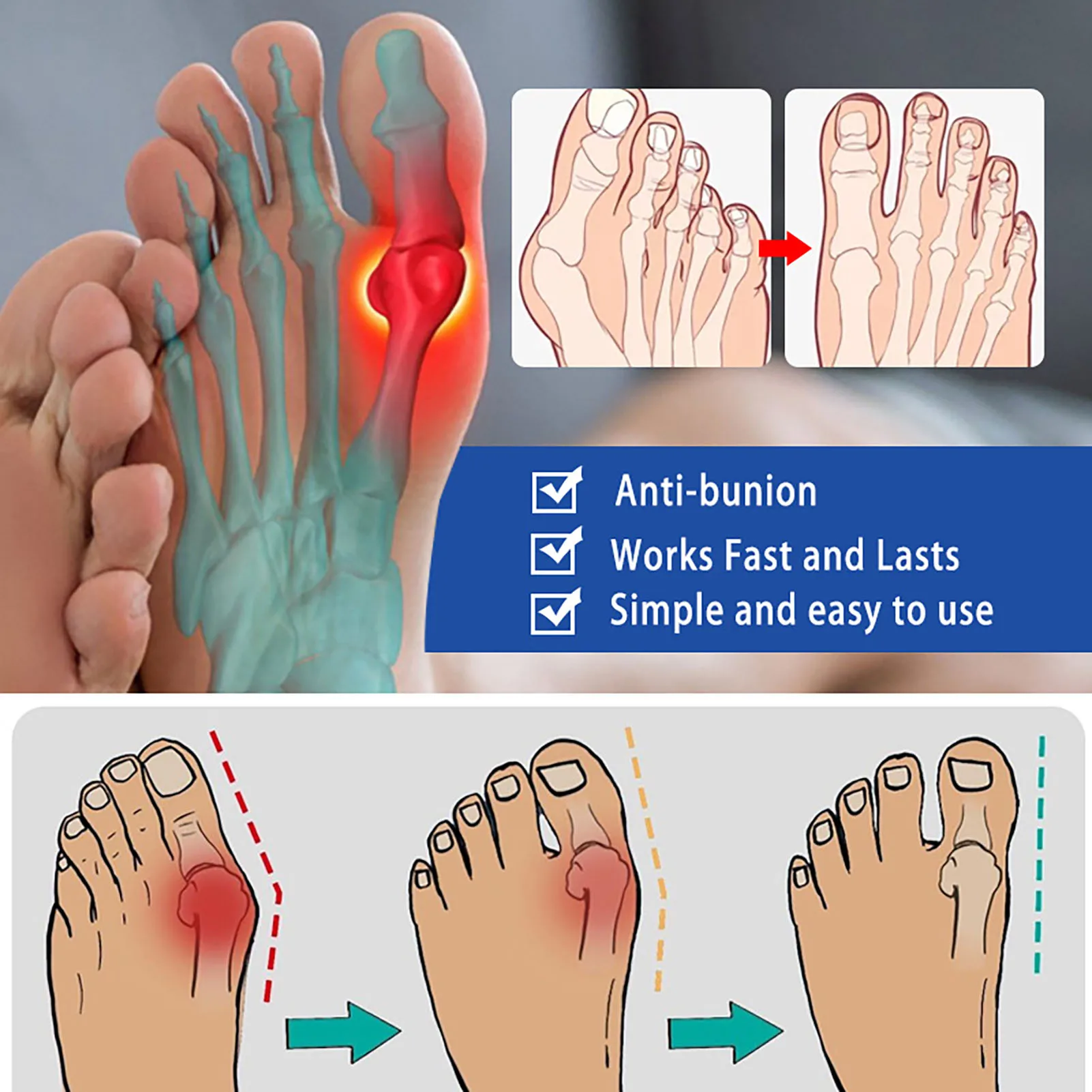 24pcs Gout Treatment Pain Relief Patch for Limb Stiffness Toe Finger Bunion Hallux Valgus Corrector Patch Arthritis Joint Foot Care hallux valgus toe corrector,wormwood pain relief patch