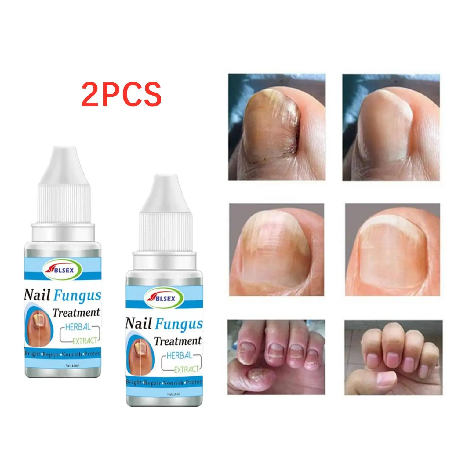 

2X Fungus Nails Treatment for Fingernails Toenails Repair Onychomycosis Paronychia Anti Infection Toe Nail Fungal Removal Liquid