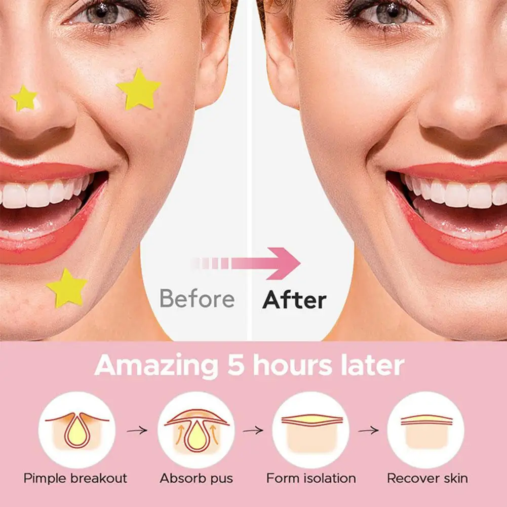 Counts Cute Colorful Butterfly Pimple Patches Acne Treatment Stickers Invisible Acne Cover Face Spot Pimple Patch Skin Care