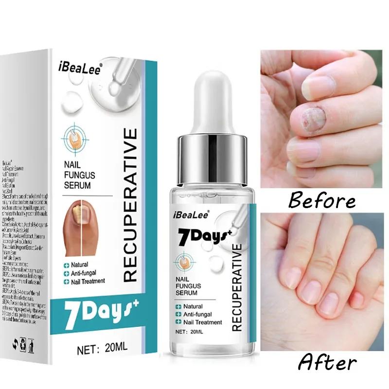 

Nail Fungus Treatment Essence Hand and Foot Care Onychia Lateralis Remova Repair Gel Anti-infective Thickening Soft Nail Product