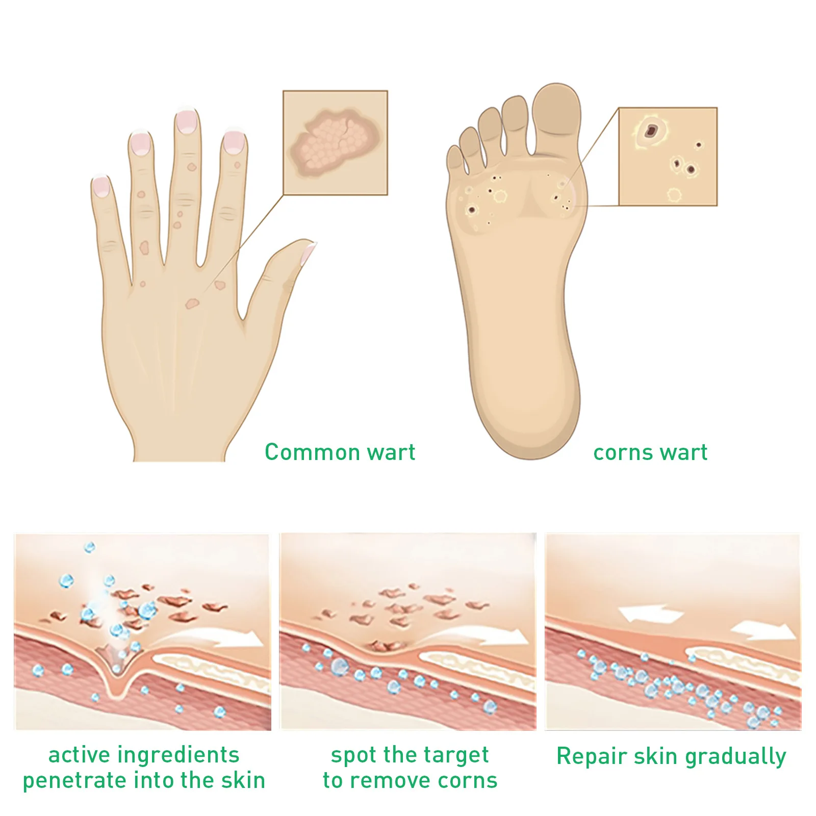Manicure Pedicure Tools Personal Health Care Pain Analgesic Cream Foot Corn Removal Cream Chicken Eye Skin Infection Treatment Chicken Eye Solution Foot Dead Skin Scab Removal Tool Health발톱무좀