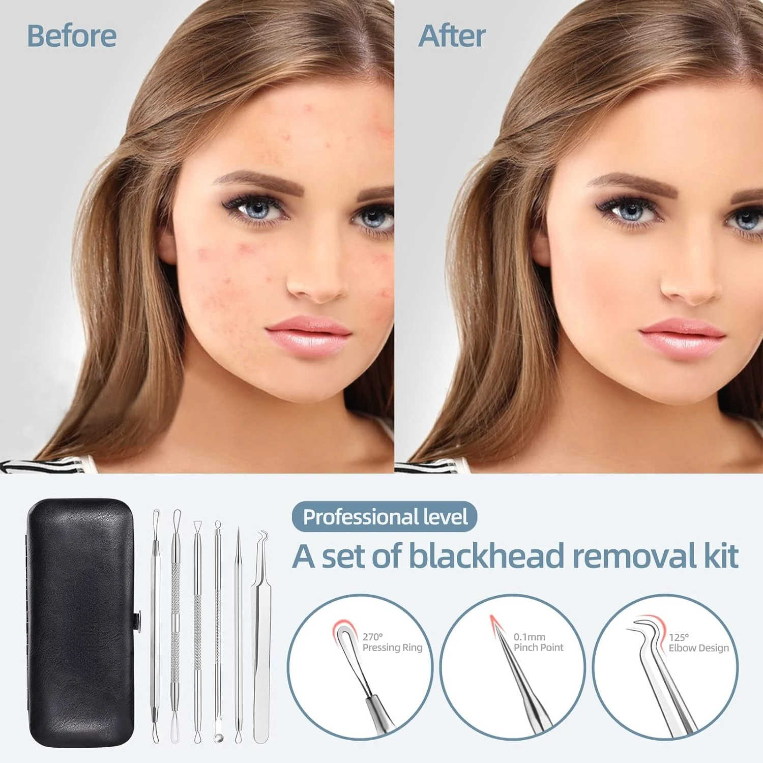 Premium 6-Piece Superior Blackhead Remover Kit for Clearer Skin-High-Quality Professional Tools in Stylish Leather Bag-Ultim