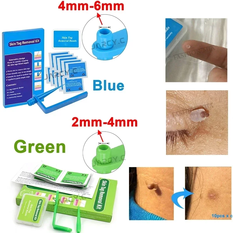 Skin Tag Removal Kit Papilloma Removal Skin Cleansing Band Kit For Remove Berrugas Wart Dots Mole Beauty Appliances