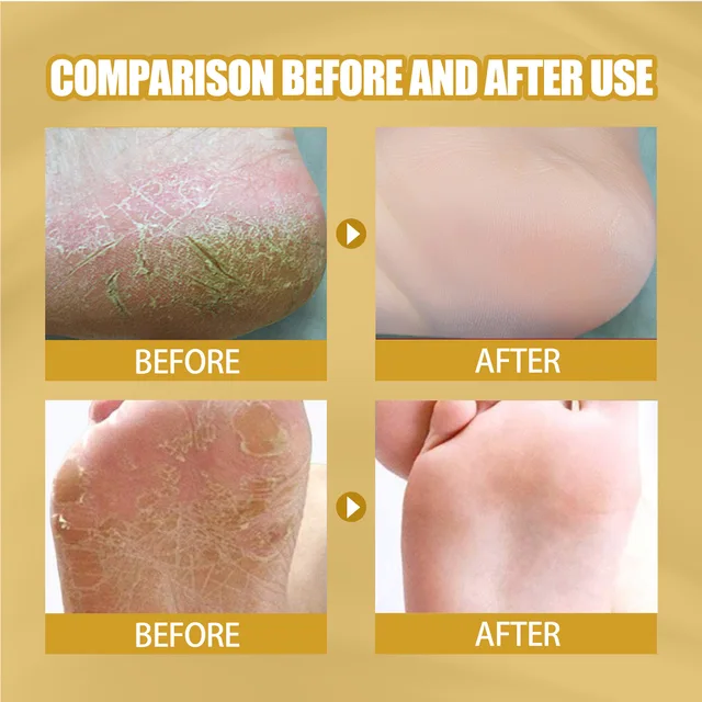 AntiDrying Crack Foot Cream Heel Cracked Repair Banana Oil Anti