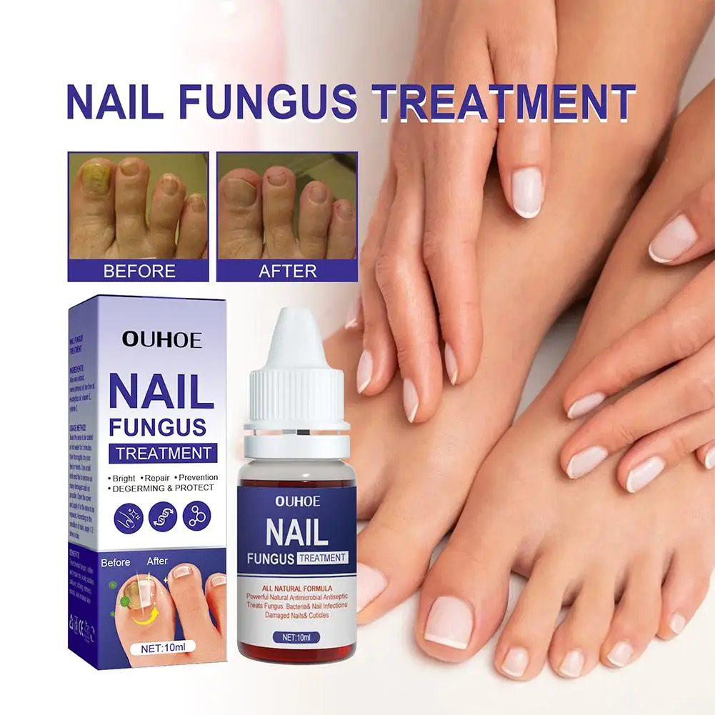 1PCS Nail Fungal Treatment Feet Care Essence Anti Infection Fungus Onychomycosis Paronychia Fungal Toe Nail Removal Serum R D9Z3