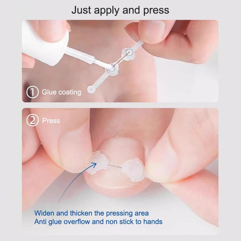 1PC Ingrown Toenail Correction Tool Ingrown Toe Nail Treatment Elastic Patch Sticker Straightening Clip Brace Pedicure Tool toe corrector manicure pedicure tools