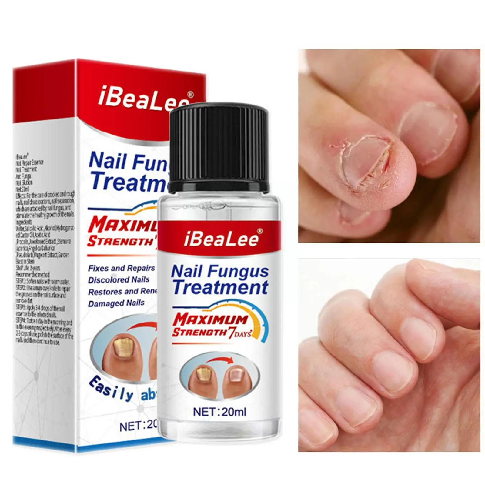 Sérum de traitement des champignons des ongles, 20ml, huile de soin pour  les mains, gel réparateur et anti-infectieux T4B9 - AliExpress