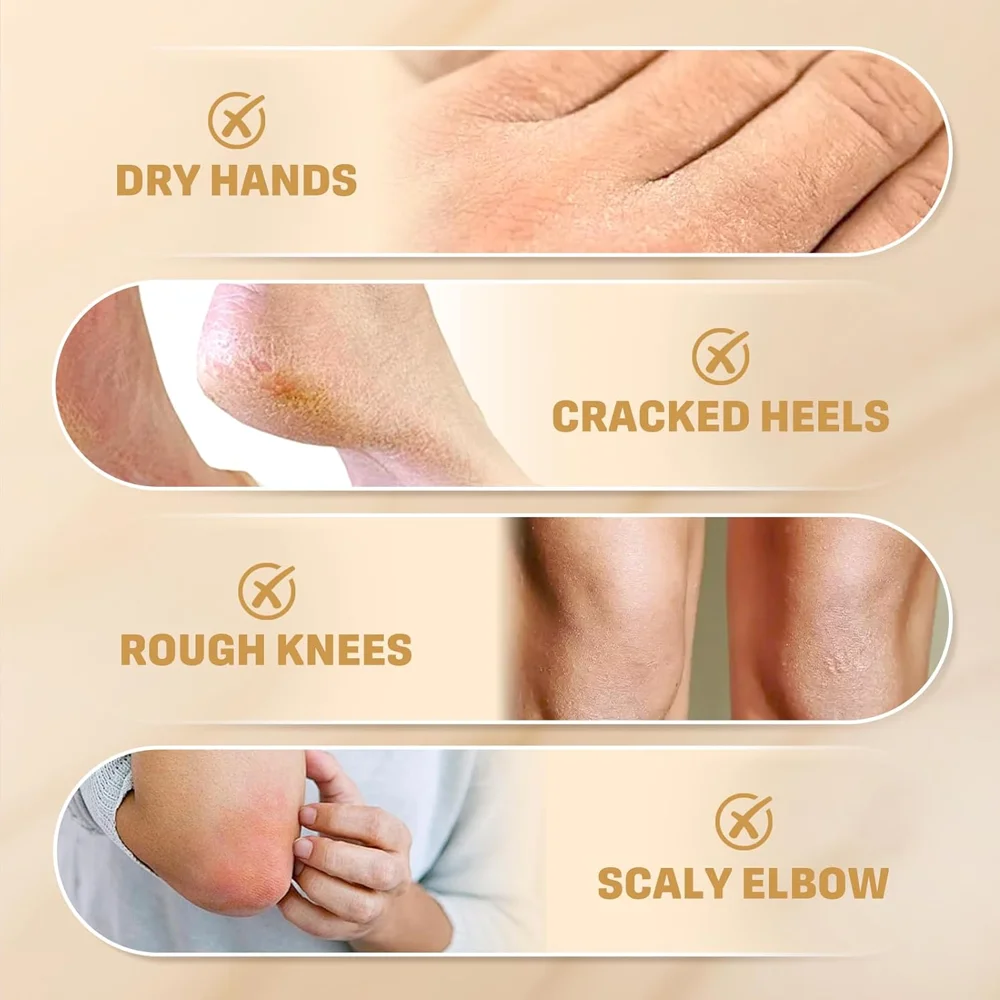 YUITIKUE 60% Urea Cream2% Salicylic Acid ComfortSuitable for rough, thick, dry, and cracked skinMoisturizes your skin