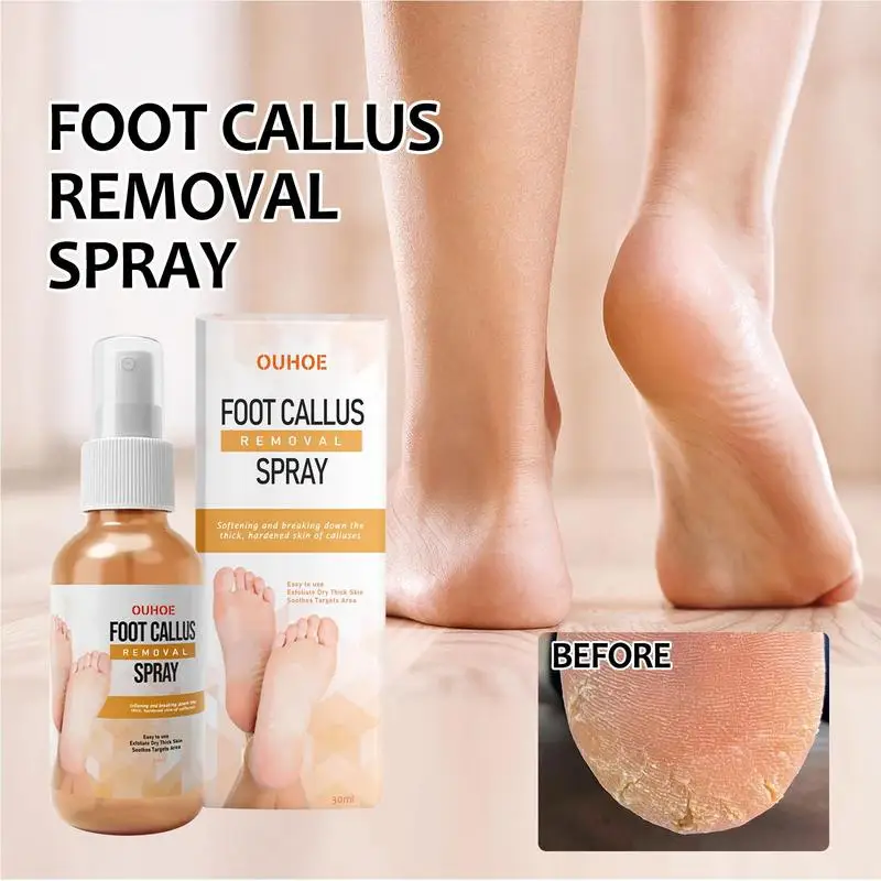 Foot Callus Remover Spray 1.01 Oz Quickly Soften Calluses