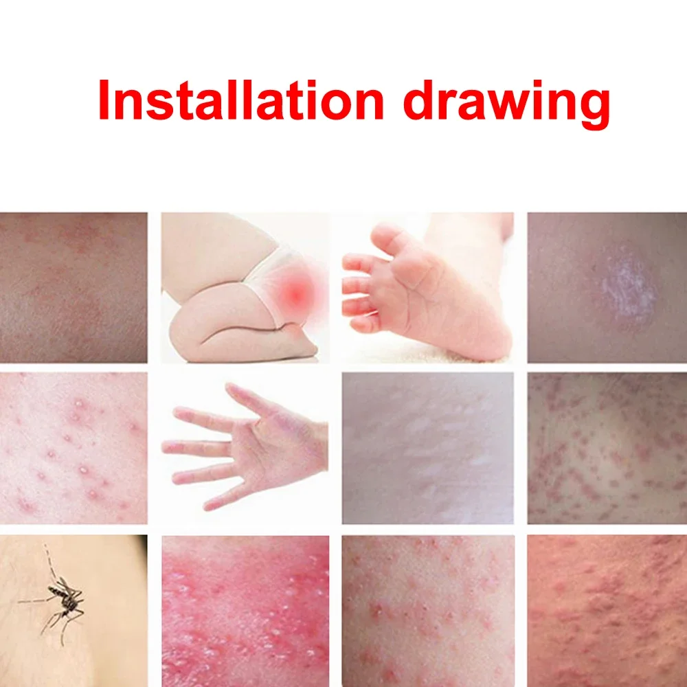 15 جرام كريم مرهم الصدفية العشبي الطبيعي الأكزيمات...