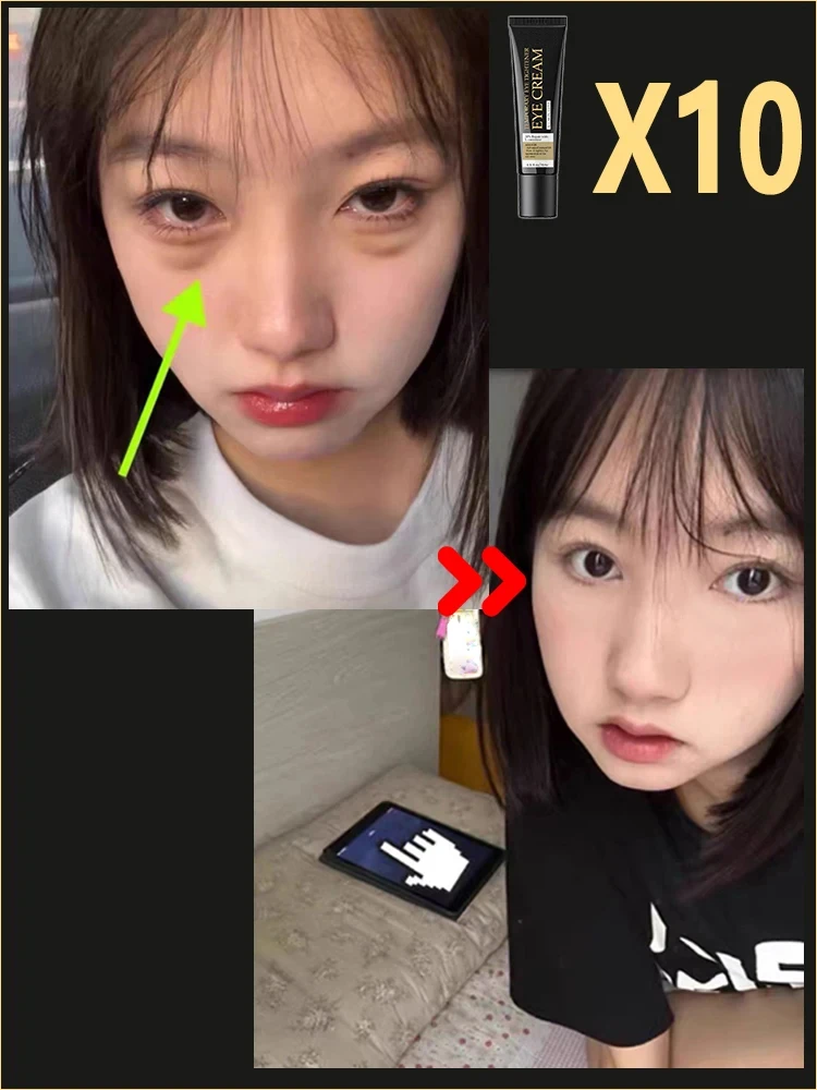Eye cream Under eye bag puffy fat removal