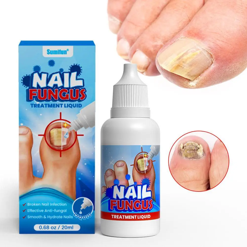 

Nail Fungal Treatment Feet Care Essence Nail Foot Care Toe Nail Fungus Removal Gel Anti Infection Paronychia Onychomycosis 20ML