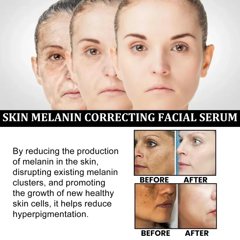 Whitening Freckle Serum Fade Melasma Dark Spots Remove Pigment Brighten Lighten Melanin Improve Dull Anti-aging Face Skin Care