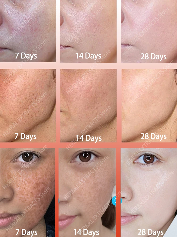 

Melanin Correcting Serum Fade Dark Spots Anti Freckle Melasma Remover Lightening Pigment Blemish Vitamin C Face Essence