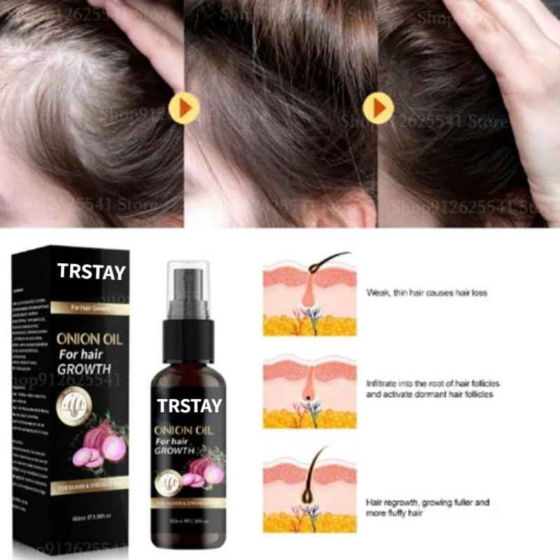 Onion Oil For Hair Growth Alopecia Hair Treatment For Women Treatment