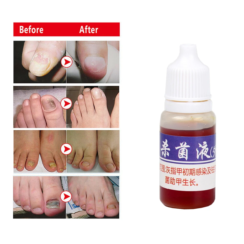 Nail Fungus Remover Anti Infection Fungal Nail Treatment Liquid Gel