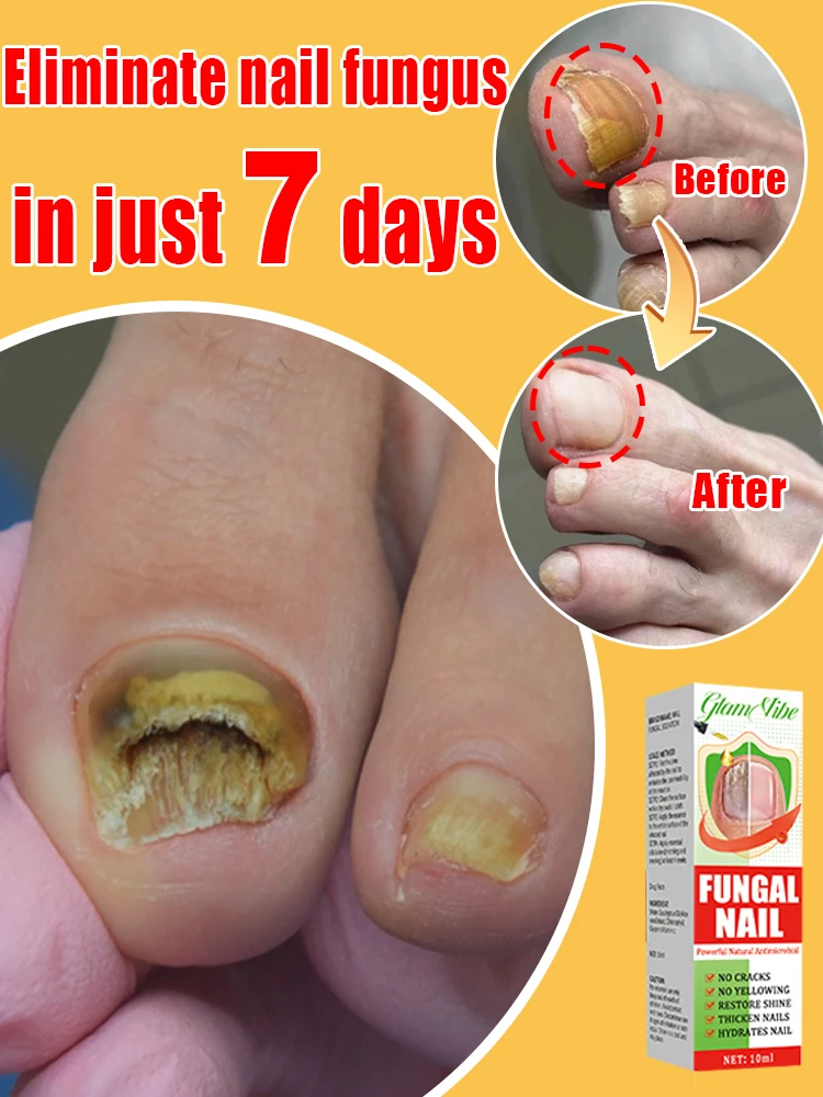 Fungus Solution Technology in 2024 Completely Solve the Problem of Fungus