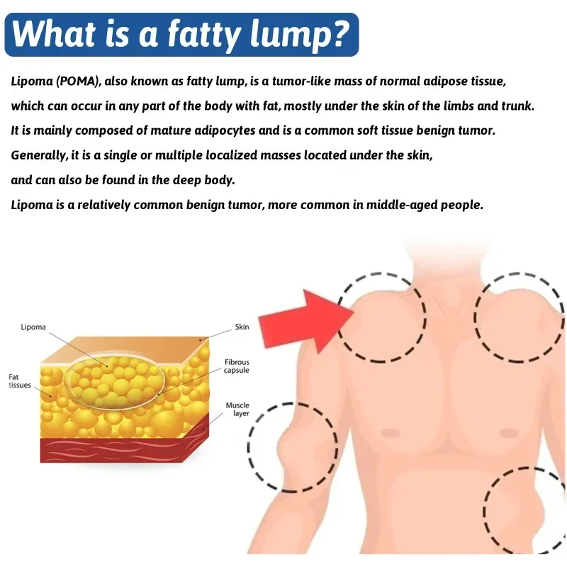 Lipoma Removal Ointment Cellulite Treatment Fibroma Remover Subcutaneous Lumps Multiple Lipomas Fat Mass Medicines Cream 20G cream lumps remover